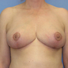 Breast Reduction