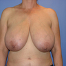 Breast Reduction