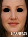 Female Revision Rhinoplasty 