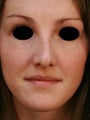 Female Revision Rhinoplasty 