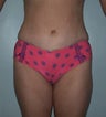 Female patient who underwent a tummy tuck 