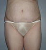 Female patient who underwent a tummy tuck 