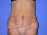 lower body lift