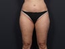 Liposuction Abdomen, Flanks, Inner & Outer Thighs