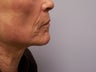 Ablative Laser Resurfacing