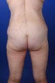 32 Year Old Femal Weight Loss Patient After Gastric Bypass Treated with Body Lift