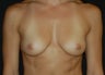 Breast Augmentation