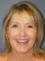 SMAS Facelift, LiteLift, Mini Lift