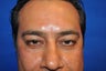 43 Year Old Male treated with Lower Eyelid Surgery to remove Puffy Eye Bags