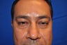 43 Year Old Male treated with Lower Eyelid Surgery to remove Puffy Eye Bags