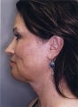 Liposuction Face and Neck