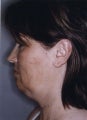 Liposuction Face and Neck