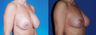 Revision Breast Surgery