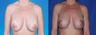 Revision Breast Surgery