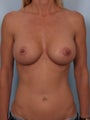 Breast Augmentation
