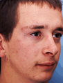 Scar Revision