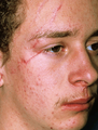Scar Revision