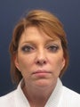 Lower facelift in Woman