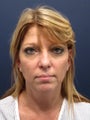Lower facelift in Woman