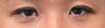 Bilateral Asian Eyelid Surgery