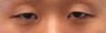 Bilateral Asian Eyelid Surgery