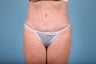 Tummy Tuck