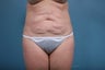 Tummy Tuck