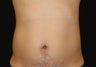 CoolSculpting by zeltiq
