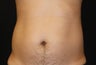 CoolSculpting by zeltiq