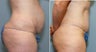 34 year old with excess abdominal skin
