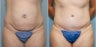 34 year old with excess abdominal skin