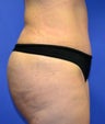 38 year old with lack of gluteal volume