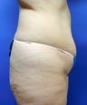 38 year old with lack of gluteal volume