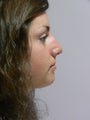 Rhinoplasty