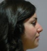 Rhinoplasty