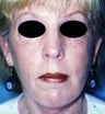 64 year old female patient 