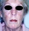 64 year old female patient 