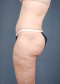 Tummy Tuck (Abdominoplasty)