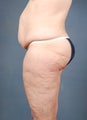 Tummy Tuck (Abdominoplasty)