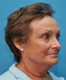 Facelift