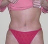 Tummy Tuck