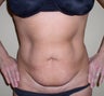 Tummy Tuck