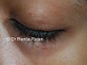 Cosmetic Mole Excision 