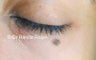 Cosmetic Mole Excision 
