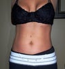 Vaser liposuction