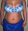 Vaser liposuction