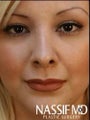 Hispanic Female Revision Rhinoplasty 