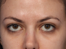 Botox Between Eyebrows