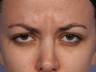Botox Between Eyebrows