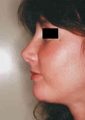 Revision Rhinoplasty